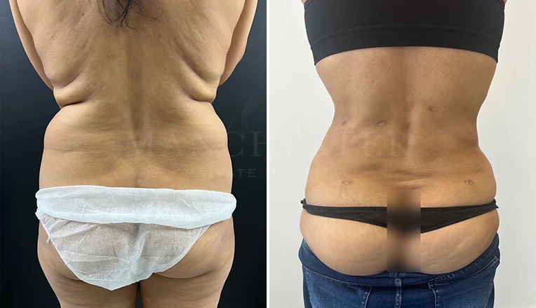 back vaser lipo before and after result-16