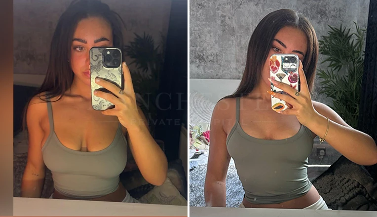 breast reduction surgery before and after-patient-11