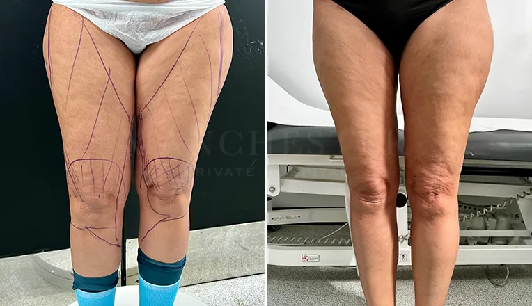 inner thigh liposuction before and after