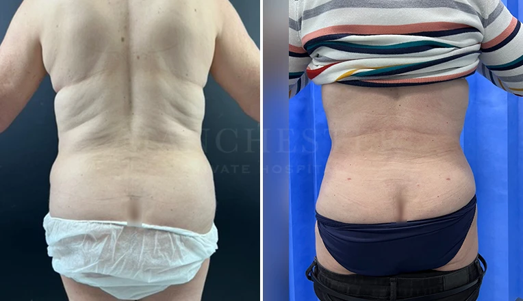 love handle lipo before and after result-15