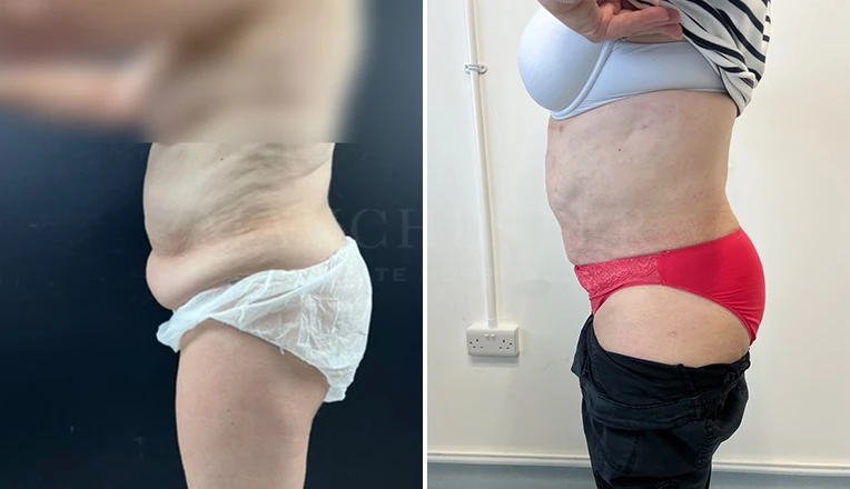 stomach vaser lipo before and after result-15-v1