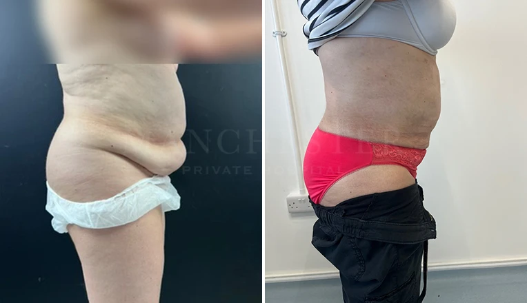 stomach vaser lipo before and after result-15-v2