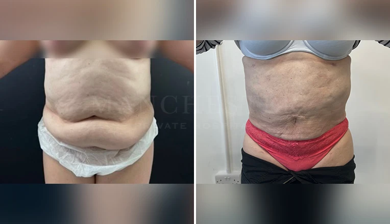 stomach vaser lipo before and after result-15