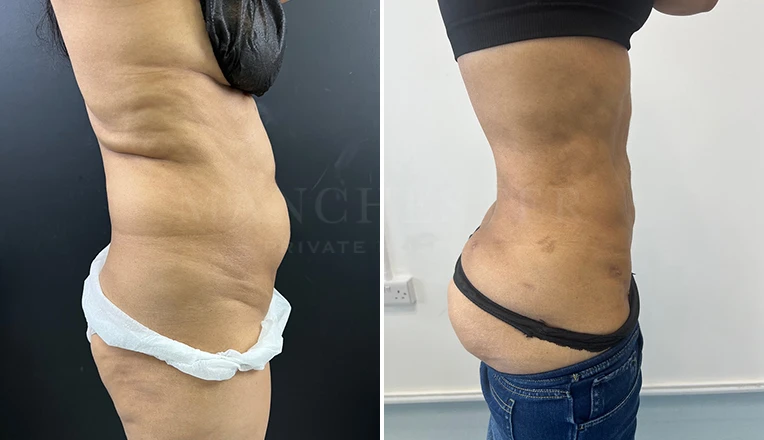 stomach vaser lipo before and after result-16-v2