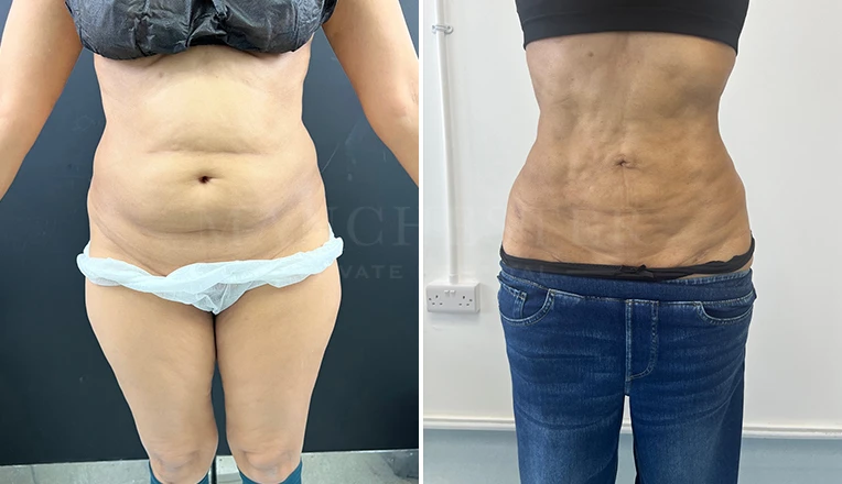 stomach vaser lipo before and after result-16