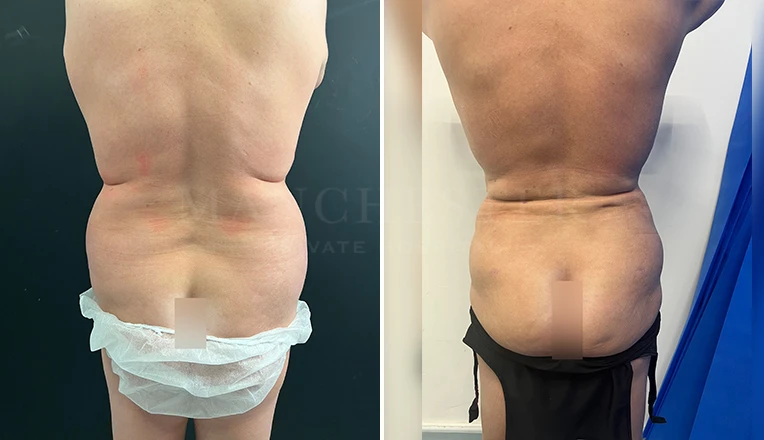 back vaser lipo before and after result-17