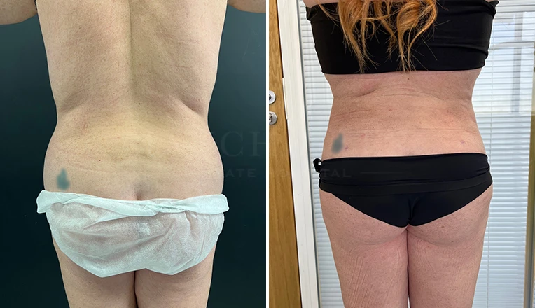 back vaser lipo before and after result-18