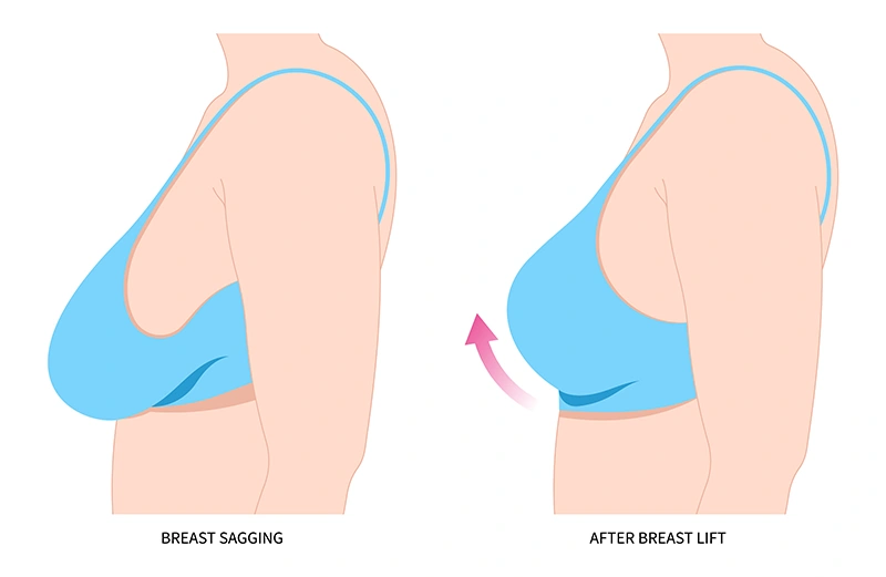 Diagram showing before and after results of breast lift surgery