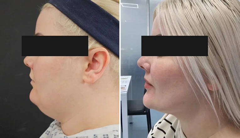 chin vaser liposuction before and after-4-v1