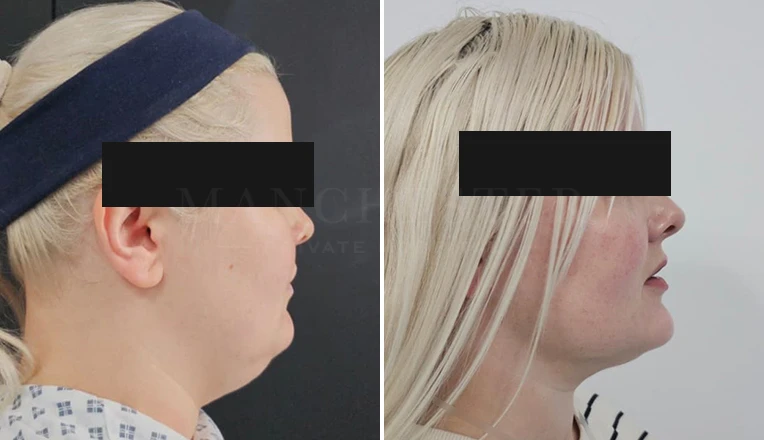 chin vaser liposuction before and after-4-v2