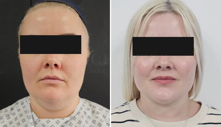 chin vaser liposuction before and after-4