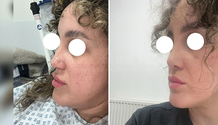rhinoplasty before and after patient-16