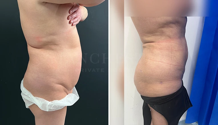 stomach vaser lipo before and after result-17-v1