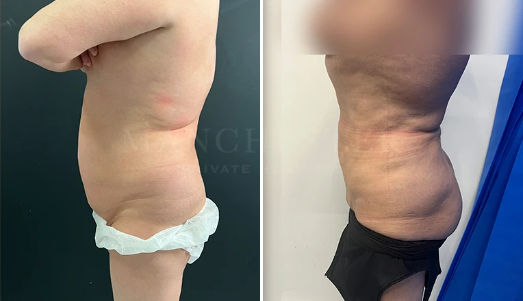 stomach vaser lipo before and after result-17-v2