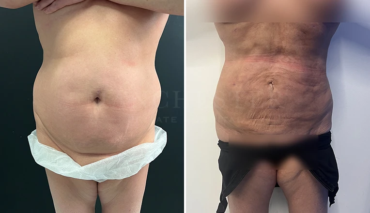 stomach vaser lipo before and after result-17
