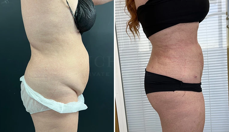 stomach vaser lipo before and after result-18-v1