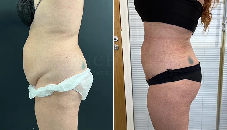 stomach vaser lipo before and after result-18-v2