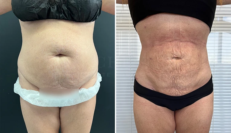 stomach vaser lipo before and after result-18