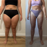 Lipoedema Awareness Month: My Personal Story of Surgery, Recovery, and Renewal