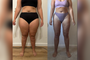 Lipoedema Awareness Month: My Personal Story of Surgery, Recovery, and Renewal