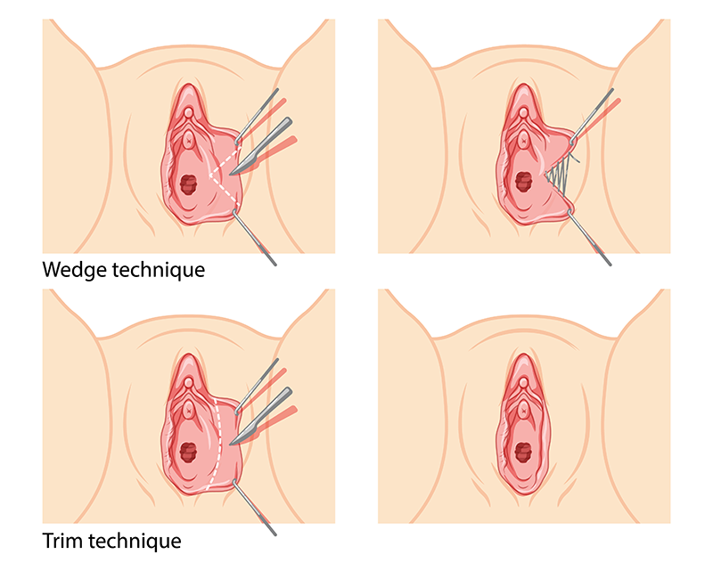 labiaplasty-techniques