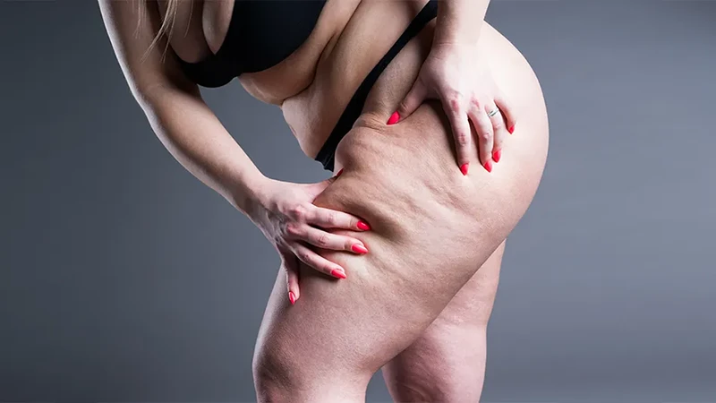 lipoedema-thigh-close-up