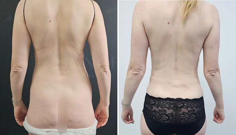 back vaser liposuction before and after result-16