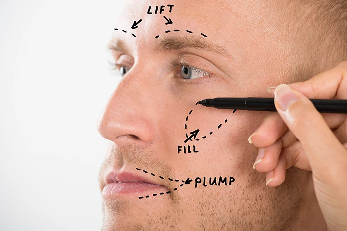 male-facial-cosmetic-surgery-markings