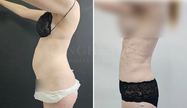 stomach vaser lipo before and after result-16