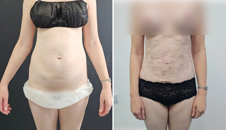 vaser lipo before and after stomach result-16
