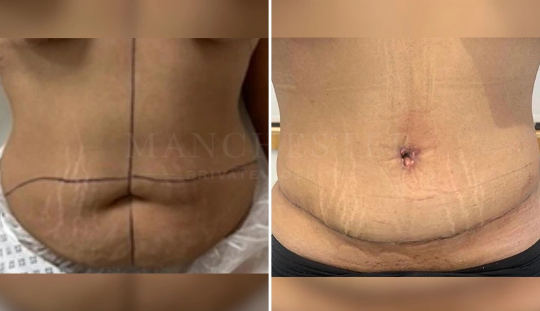abdominoplasty before and after result