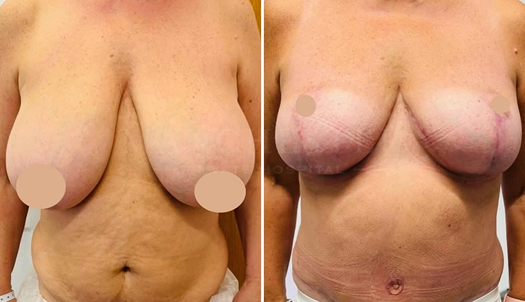 abdominoplasty combines with vaser liposuction and breast reduction