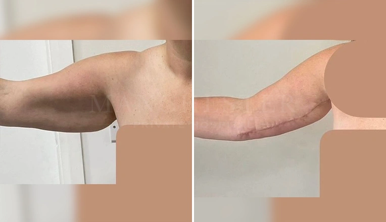 arm lift before and after result-1
