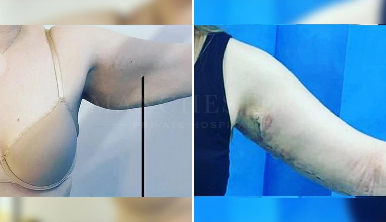 arm lift before and after result-2-v1