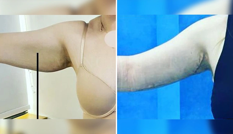 arm lift before and after result-2