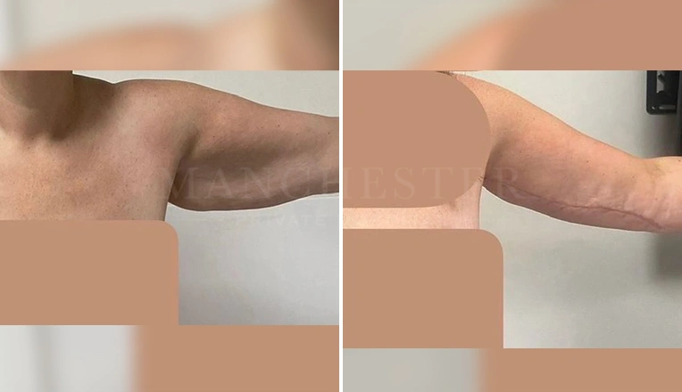 arm lift before and after result