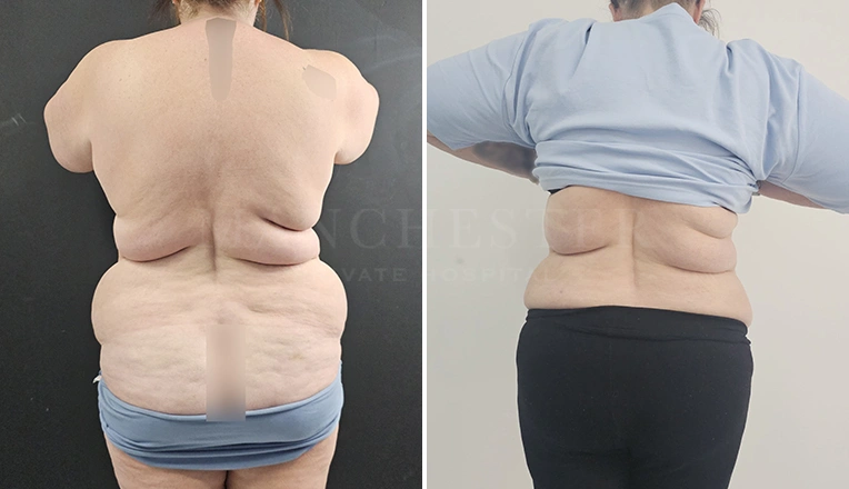 back vaser liposuction before and after result-18