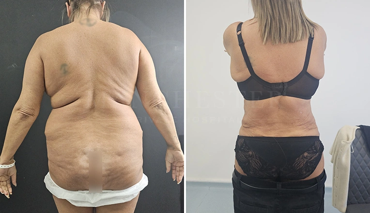 back vaser liposuction before and after result-19
