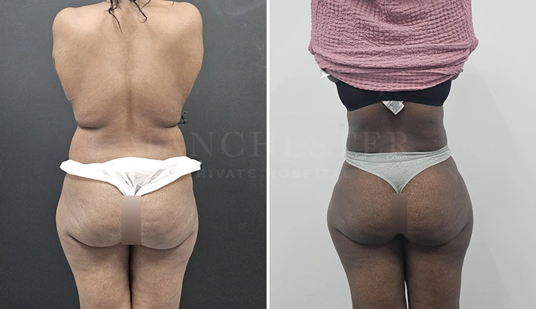 back vaser liposuction before and after result-20
