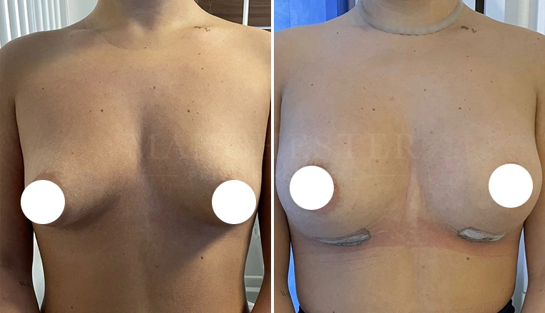 breast augmentation before and after-15