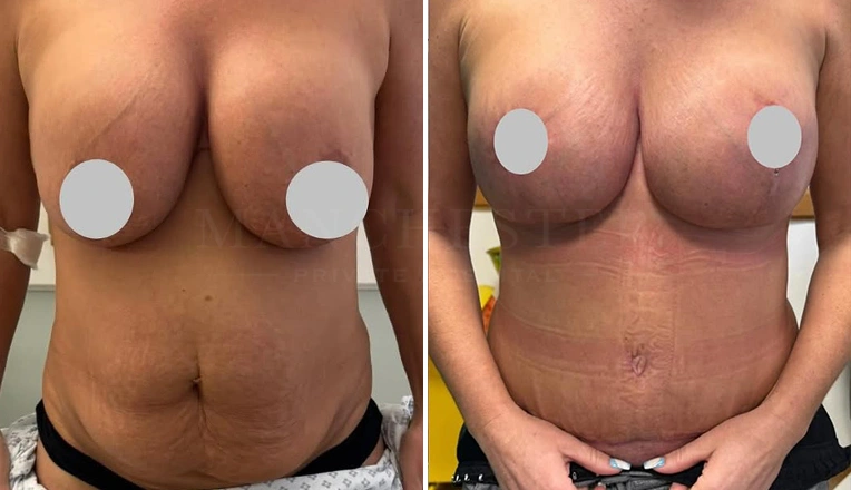 breast-augmentation-lift-and-tummy-tuck
