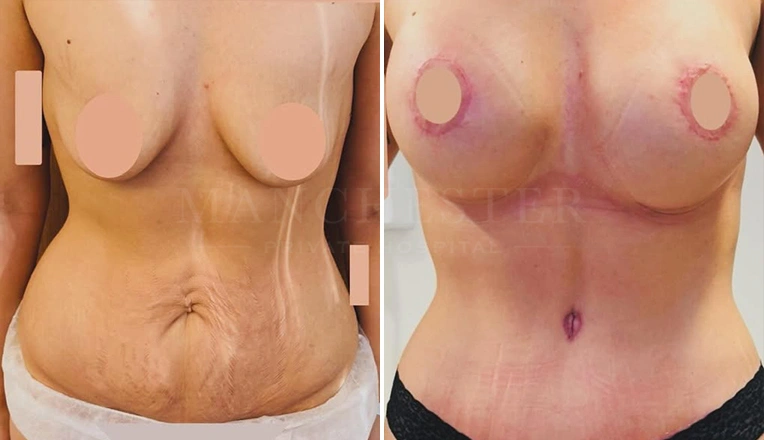 breast-enhancement-with-an-uplift-and-a-tummy-tuck