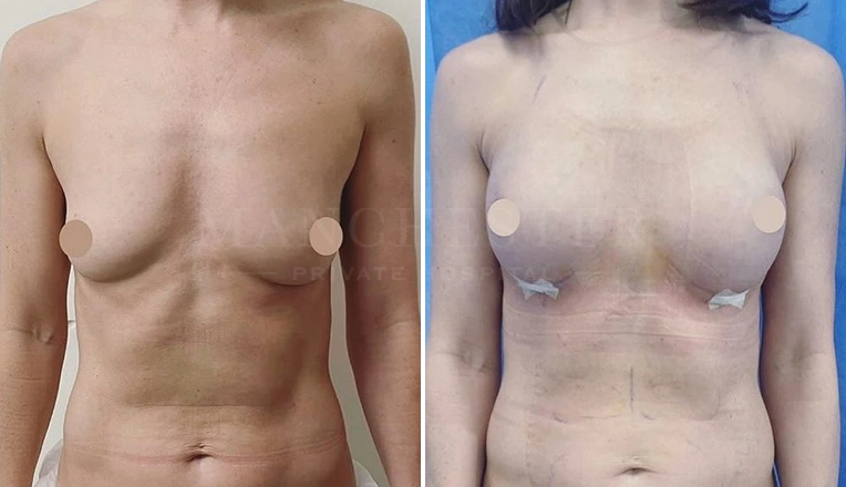 breast enlargement before and after-16