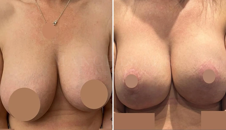 breast lift and enhancement before and after