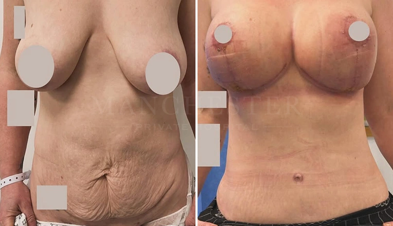 breast-lift-and-tummy-tuck