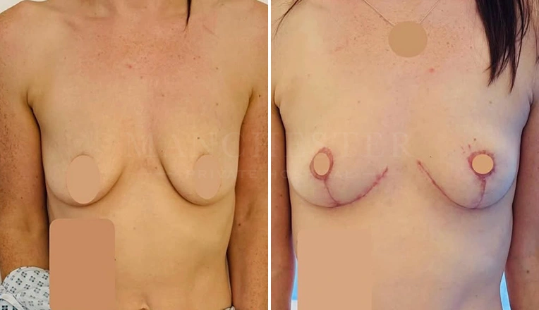 breast lift before and after