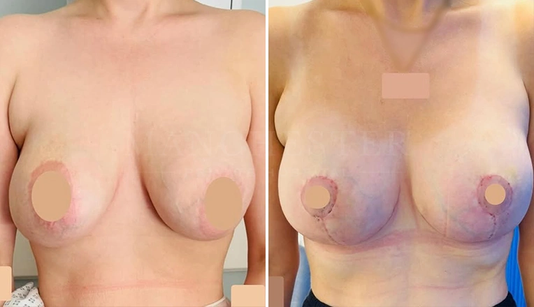 breast lift before and after