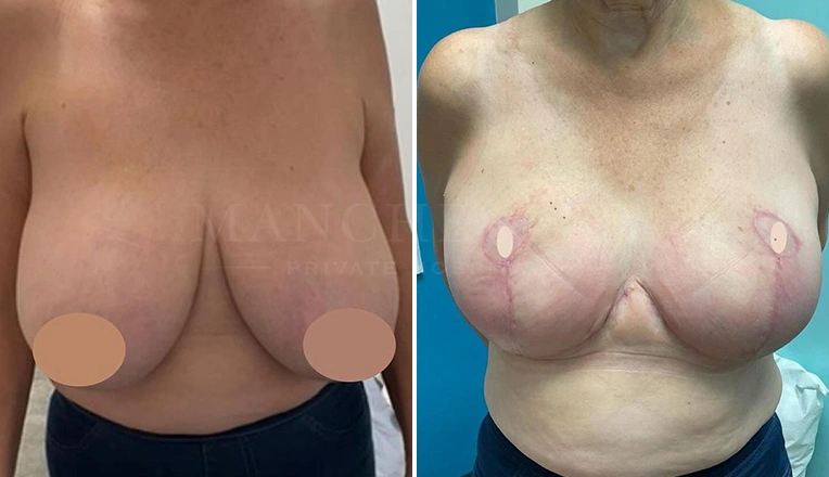 breast reduction before and after