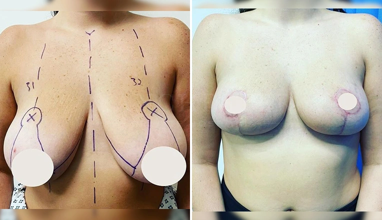 breast reduction before and after