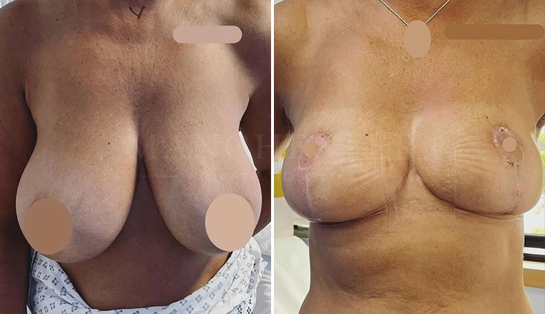 breast reduction before and after